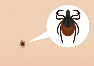 What Is Lyme Disease Symptoms Treatment And Prevention Practice