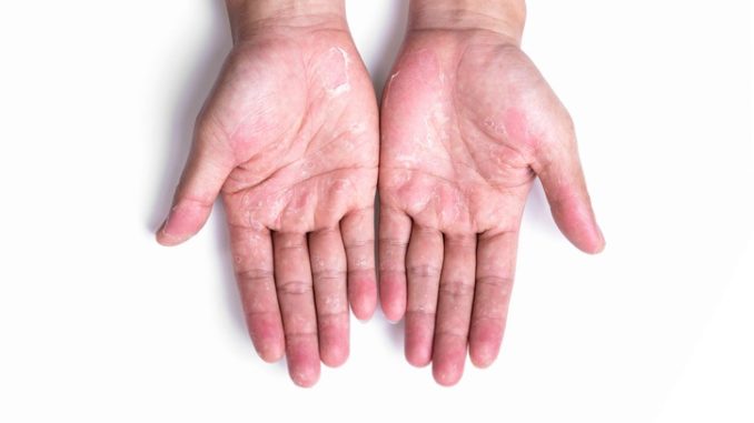 Red-raw, dry and sore? Protecting your hands during COVID ...