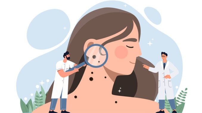 Skin Cancer concept. Doctors with magnifying glasses in their hands examine girl skin and find melanoma in form of mole. Oncology or dermatological problems.
