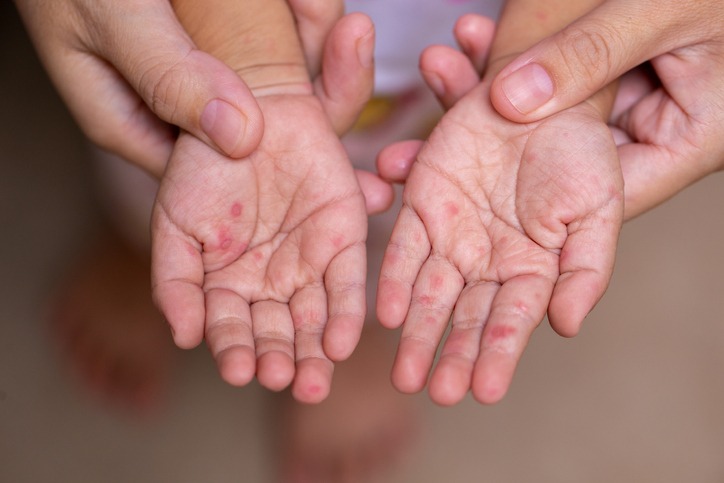 Parents hold the hands of a child with measles
