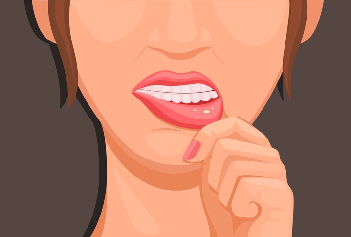 women touch lips sprue, symptoms of Stomatitis.