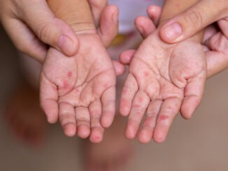 Parents hold the hands of a child with HFMD