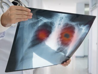 x-ray lung cancer