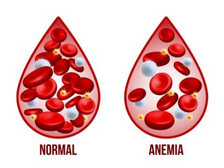 Iron deficiency anemia.The difference of Anemia amount of red blood cell and normal.