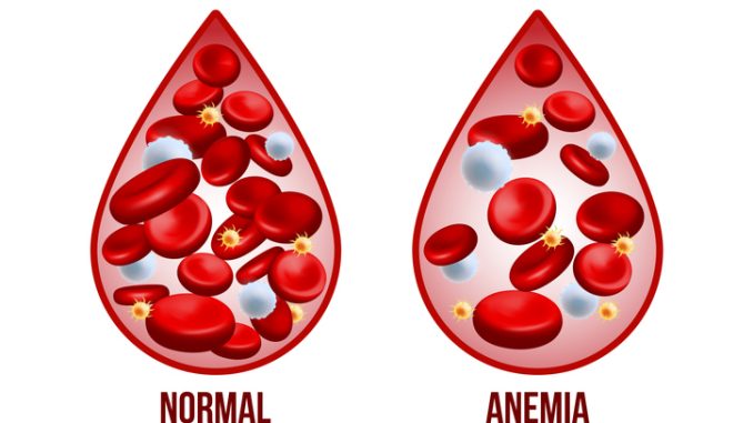 Iron deficiency anemia.The difference of Anemia amount of red blood cell and normal.