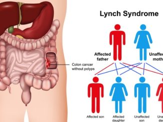 Lynch syndrome disease 3d medical vector illustration on white background