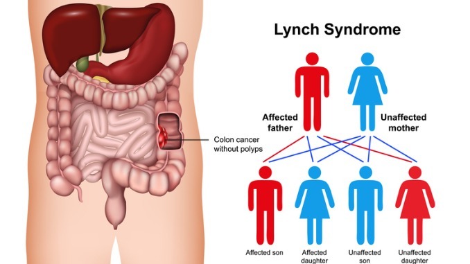 Lynch syndrome disease 3d medical vector illustration on white background 