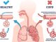 COPD or chronic obstructive pulmonary disease explanation outline