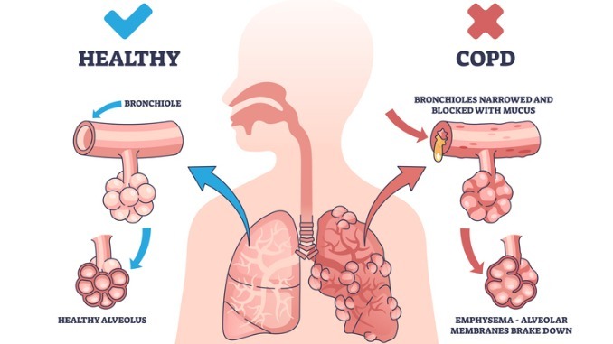 COPD or chronic obstructive pulmonary disease explanation outline